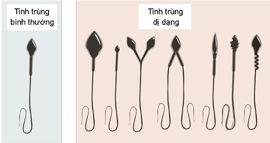 Tác hại bia rượu gây dị dạng tinh trùng