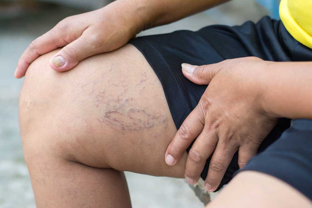 Nam giới khi bị mắc bệnh giãn tĩnh mạch thừng tinh hoàn toàn có thể mắc bệnh vô sinh
