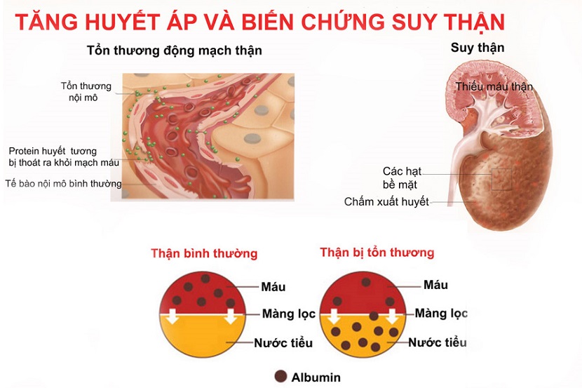 Cao huyết áp có thể gây ra biến chứng nguy hiểm là bệnh suy thận