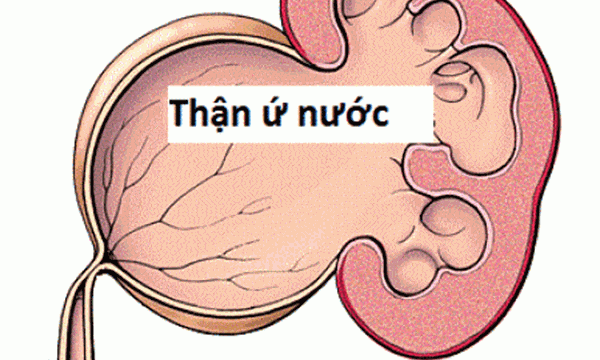 Bệnh thận ứ nước là tình trạng thận bị giãn ra và sưng to lên