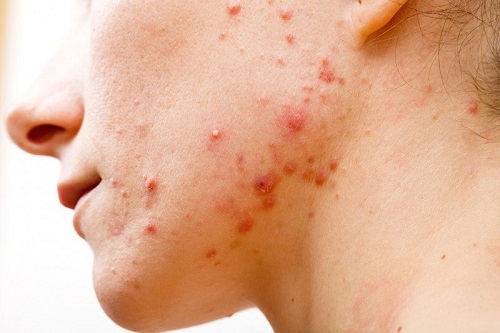 Mụn do rối loạn nội tiết tố nữ gây nhiều ám ảnh cho nữ giới