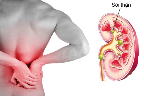Sỏi thận là một trong những nguyên nhân gây bệnh thận ứ nước