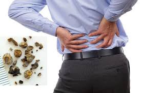 Sỏi thận có thể lớn hoặc nhỏ đến vài cm
