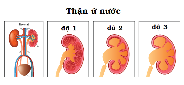Thận ứ nước khiến thận bị tổn thương giãn nở sưng to