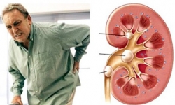 5 biến chứng nguy hiểm của sỏi thận nếu không được chữa trị kịp thời