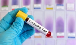 Chỉ số Creatinin là gì? ý nghĩa của chỉ số Creatinin trong cơ thể?
